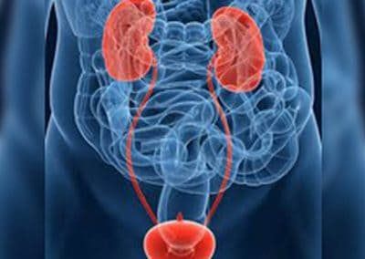 The Silent Killer: Case Of Bladder Cancer