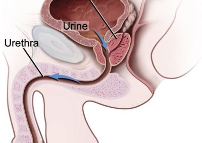 Prostate cancer rates rising in Indian men: screening is the right step in early detection