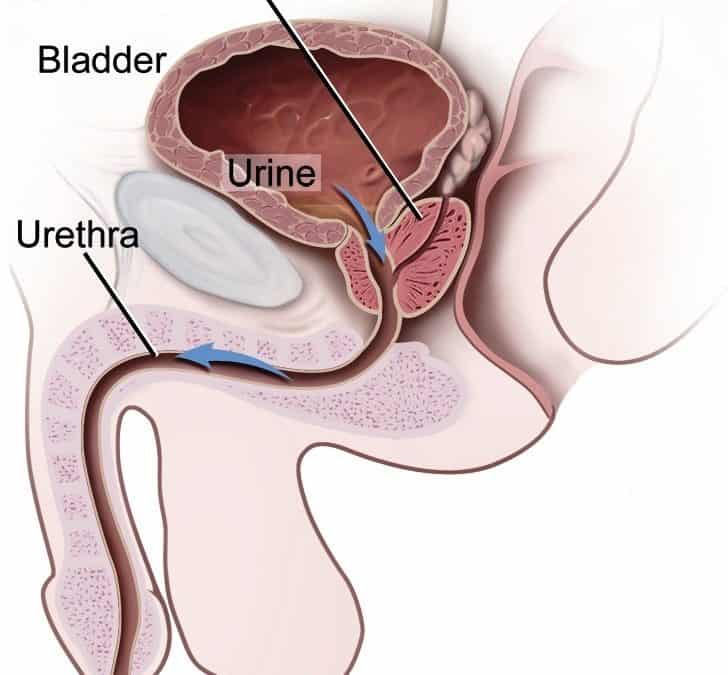 Prostate cancer rates rising in Indian men: screening is the right step in early detection