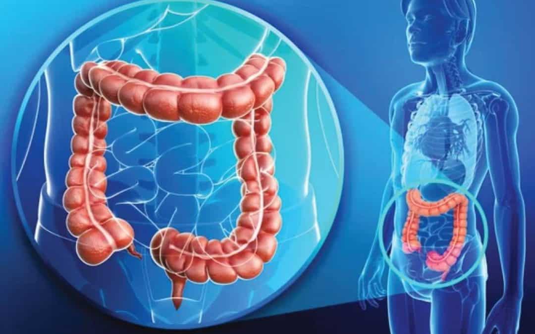 Colorectal cancers on a rise: signs and treatment
