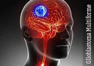 Glioblastoma (GBM) Awareness Day