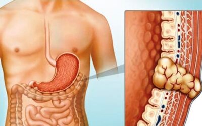 Gastrointestinal Stromal Tumors (GIST) Awareness Day