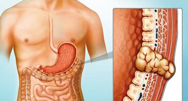 Gastrointestinal Stromal Tumors (GIST) Awareness Day