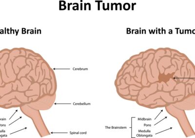 Glioblastoma (GBM) Awareness Day